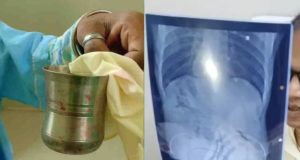 Steel Glass Inside Private Part Doctors Removed It By Surgery in Berhampur Odisha News in Hindi | दोस्तों ने मजाक-मजाक में प्राइवेट पार्ट के अंदर घुसा दिया स्टील का ग्लास, डॉक्टरों ने ऐसे निकाला ग्लास!