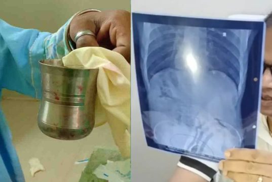 Steel Glass Inside Private Part Doctors Removed It By Surgery in Berhampur Odisha News in Hindi | दोस्तों ने मजाक-मजाक में प्राइवेट पार्ट के अंदर घुसा दिया स्टील का ग्लास, डॉक्टरों ने ऐसे निकाला ग्लास!