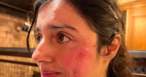 Divya Khosla Kumar Face Injury Ptotos and Images Viral on Social Media | Divya Khosla Kumar का बिगड़ा चेहरा, शूटिंग के दौरान हुए हादसे में बिगड़ी चेहरे की सूरत, तस्वीरें हुई वायरल!