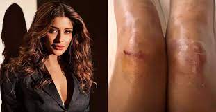 Nyra Banerjee Injured in 'Khatron Ke Khiladi 13' News, Naira Banerjee injured while performing a stunt, the picture of the accident surfaced! | श्वर्या शर्मा और अरिजीत तनेजा दोनों को चोटें लगी थीं।